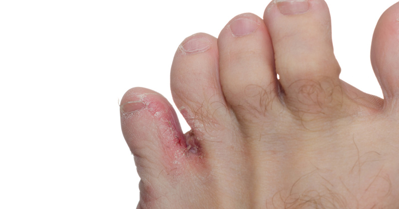 Những triệu chứng khó chịu của bệnh nấm kẽ chân