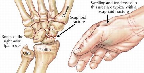 Điều trị gãy xương mu bàn tay bằng phương pháp nào?
