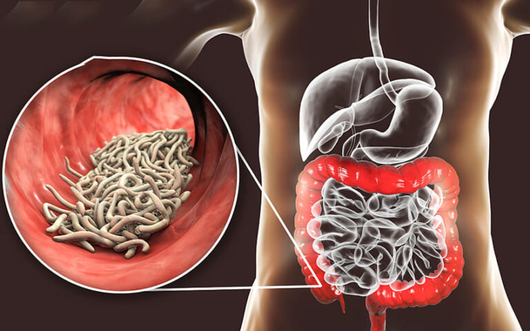 Điều trị bệnh kiết lỵ ở trẻ em và 4 câu hỏi mẹ cần biết | BvNTP