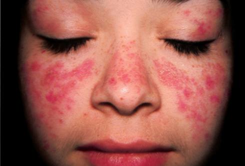 Các yếu tố nào có thể gây ra bệnh lupus ban đỏ?
