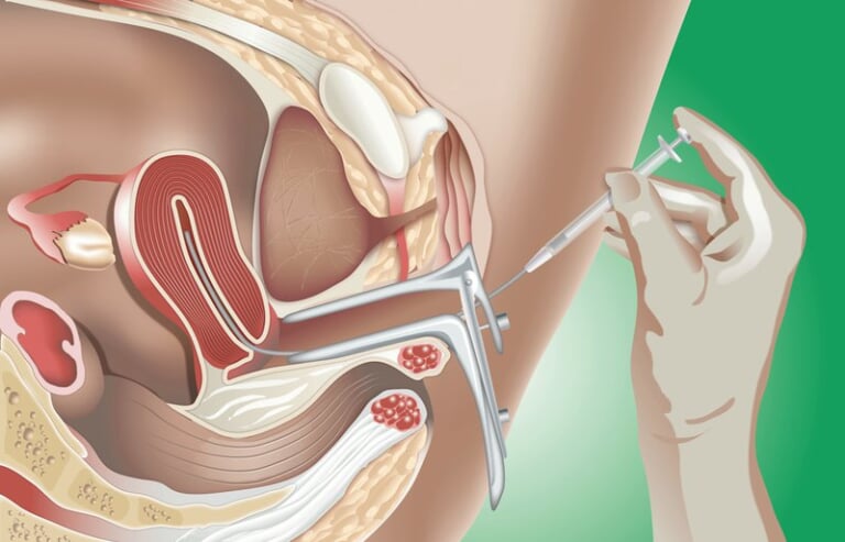 Thủ thuật: Bơm tinh trùng vào buồng tử cung (IUI) | BvNTP