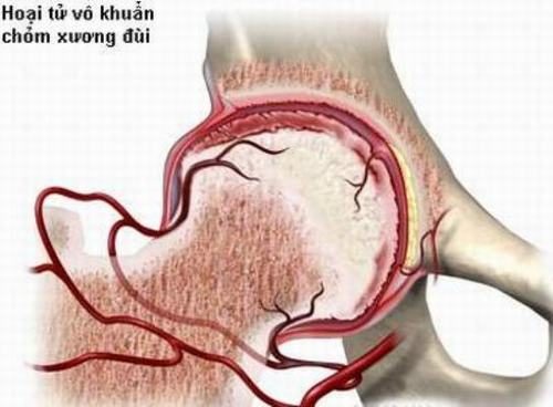 Các tác dụng phụ có thể xảy ra khi sử dụng thuốc chữa hoại tử khớp háng là gì?