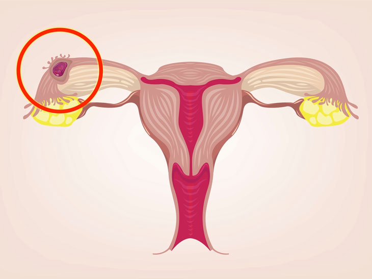 Những yếu tố nào có thể tăng nguy cơ mắc bệnh thai ngoài tử cung?
