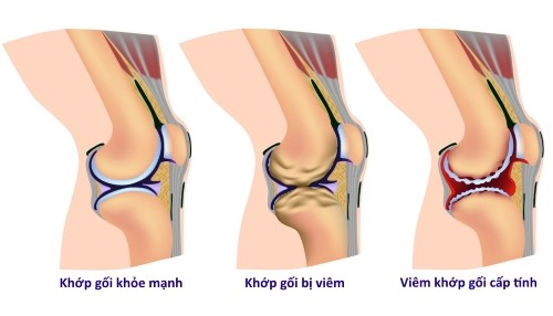 Cách phân biệt viêm khớp cấp với các bệnh khớp khác?
