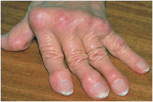 Các biến chứng có thể xảy ra do bệnh gout?
