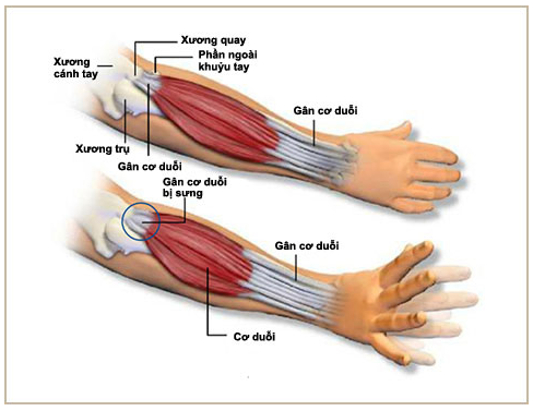 Tại sao xương cánh tay có thể gây ra cảm giác đau buốt?

