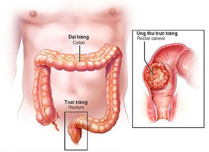 Đau hậu môn và trực tràng có thể tái phát như thế nào trong viêm trực tràng?