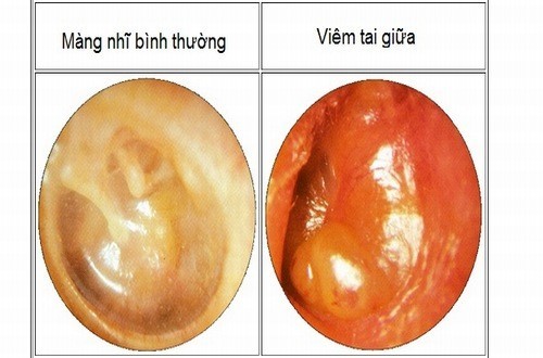 Làm thế nào để chẩn đoán viêm tai giữa?
