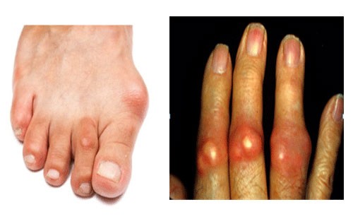Gout làm thế nào để gây ra cảm giác nóng và sưng đỏ ở khớp?
