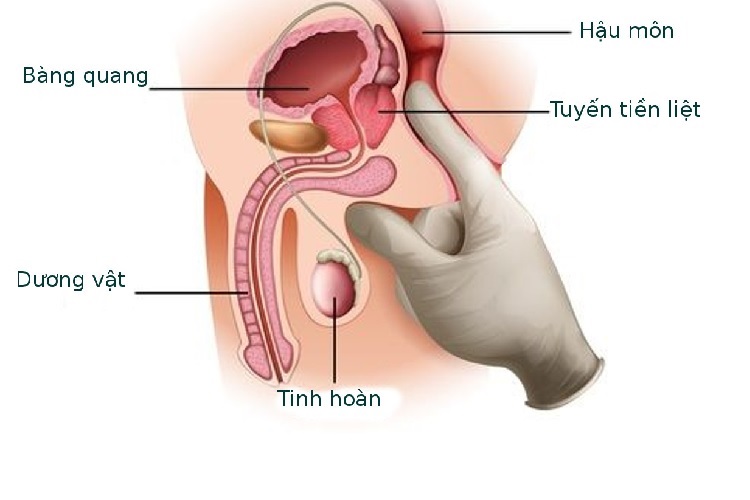 Có cần chuẩn bị gì để thực hiện đo đạc khối lượng tiền liệt tuyến trên siêu âm?