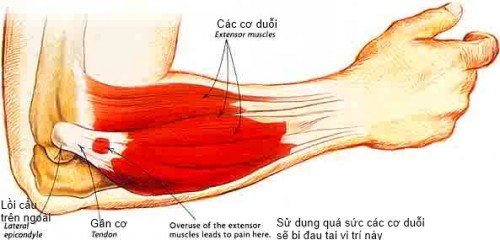 Những biến chứng nếu không điều trị đúng đắn nhức khủy tay có thể gây ra là gì?