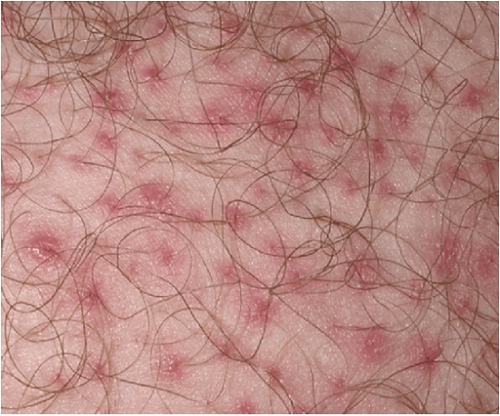 Những phương pháp điều trị viêm nang lông vùng mu hiệu quả?
