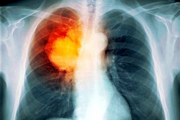 Có thể điều trị bệnh lao phổi bằng phương pháp tự nhiên không?
