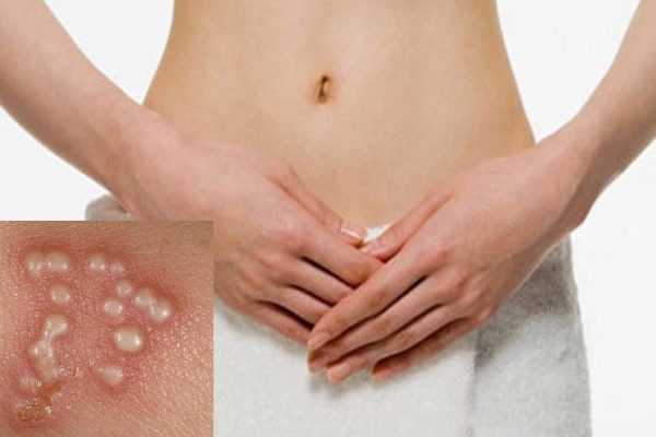 Herpes có ảnh hưởng đến tâm lý và cuộc sống của người mắc bệnh như thế nào?
