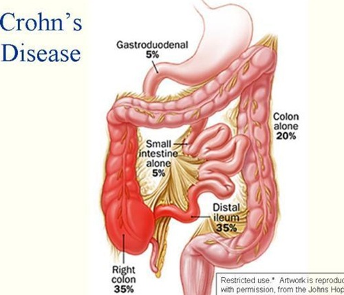 Tổng quan bệnh Crohn | BvNTP
