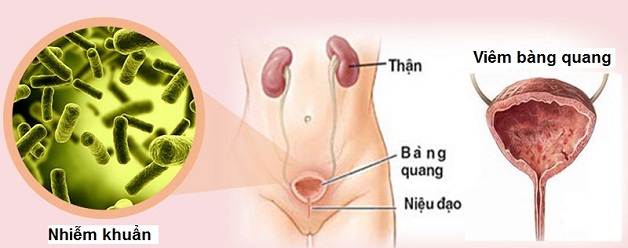 Các phương pháp điều trị viêm bàng quang mãn tính hiện nay là gì?
