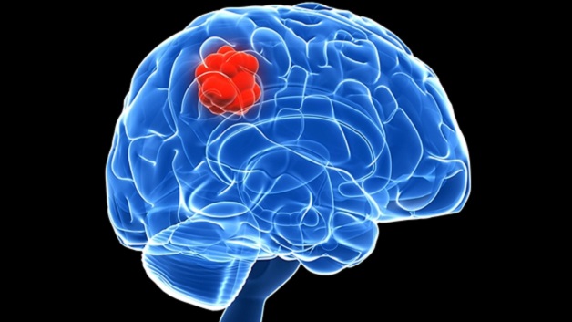 Có những biện pháp phòng ngừa nào để tránh mắc u não ác tính?
