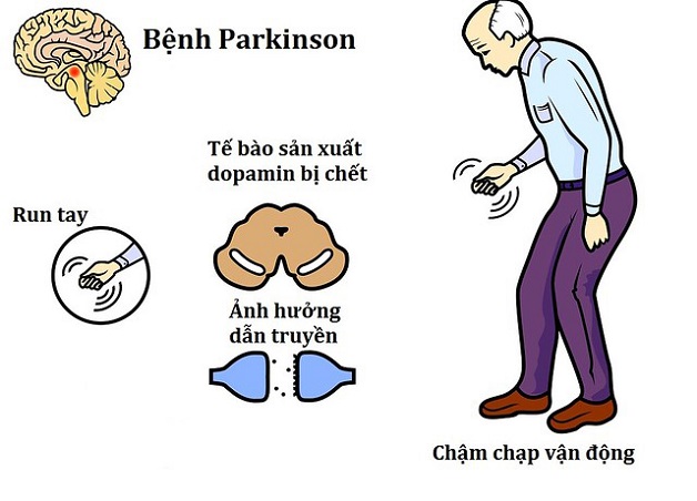 Bệnh Parkinson có thể dẫn đến các biến chứng nguy hiểm không?
