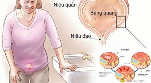 Triệu chứng chính của viêm niệu đạo nữ là gì?
