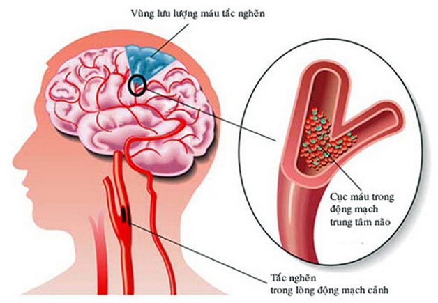 Cách chẩn đoán bệnh thiếu máu não?
