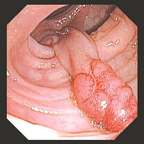 Có những yếu tố nào ảnh hưởng đến quá trình điều trị polyp hậu môn bằng thuốc?
