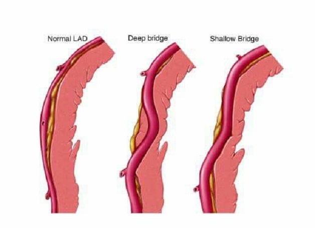 Cầu Cơ Lad là gì? Khám phá chi tiết về hiện tượng đầu tư hấp dẫn này