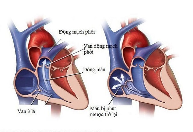 Hở van tim 3 lá 1/4 có nguy hiểm không? Cách phòng, trị bệnh | BvNTP