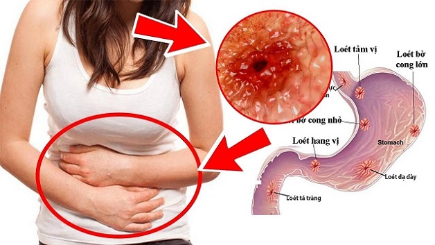 Bệnh viêm dạ dày có ảnh hưởng đến quá trình tiêu hóa không?
