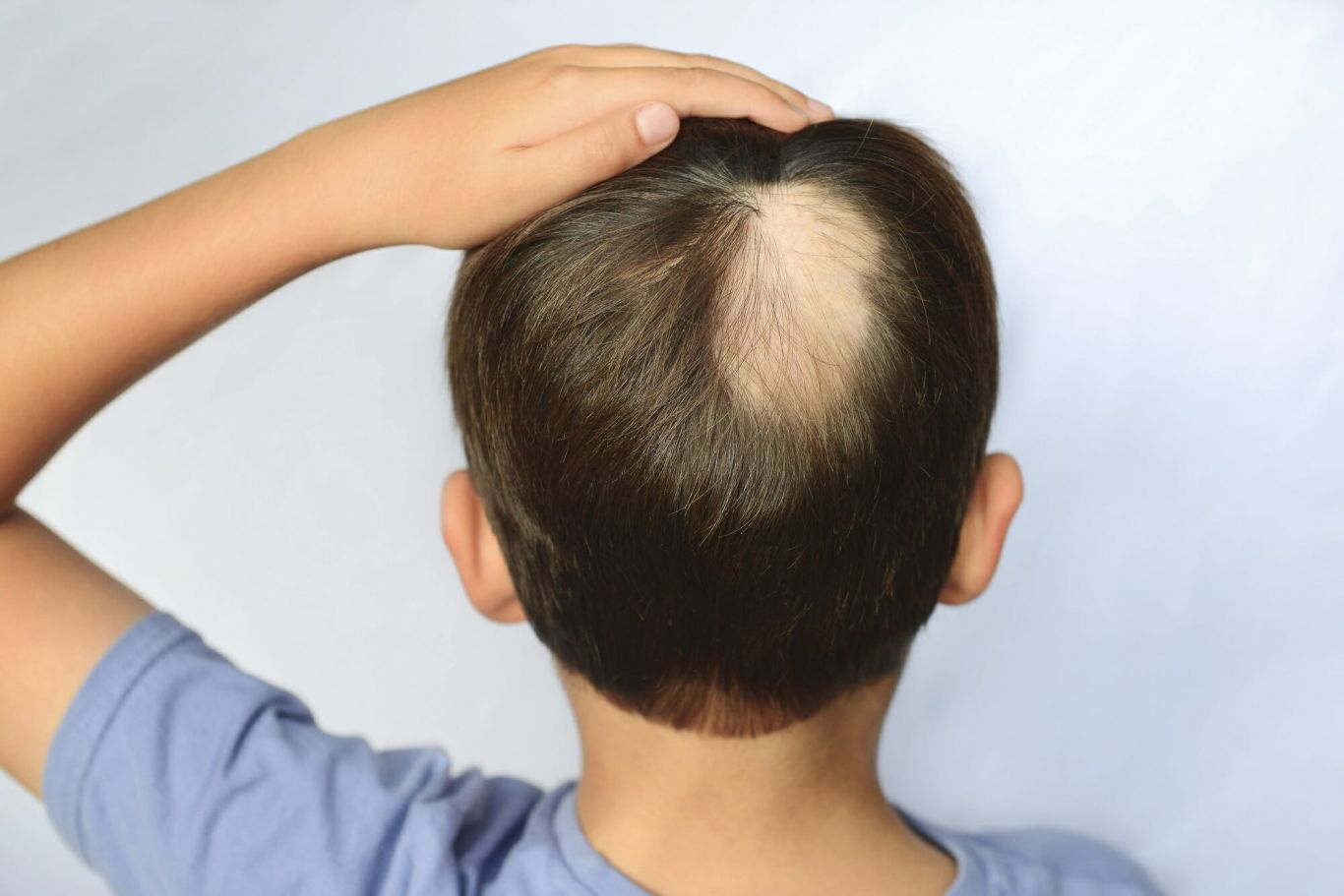 Rụng tóc nhiều ở nam Nguyên nhân dấu hiệu và cách điều trị