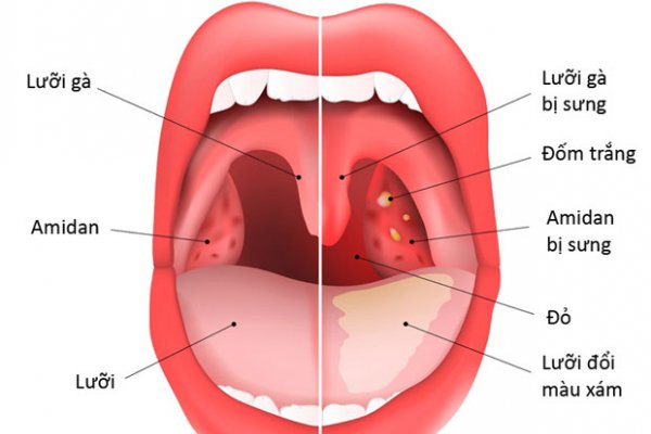 Phương pháp cắt amidan có an toàn không? Có tỷ lệ phản ứng phụ cao không?
