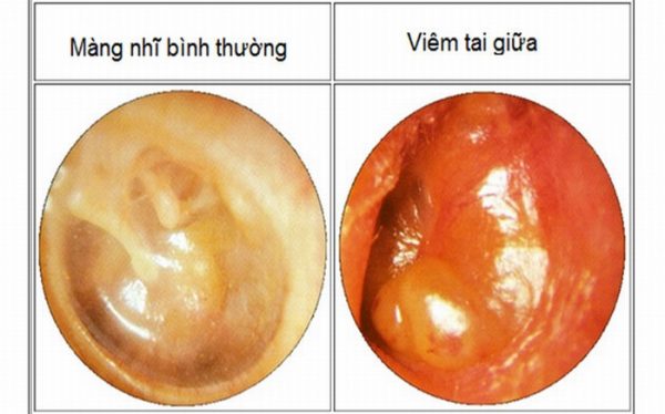 Bệnh viêm tai giữa cấp ở người lớn là gì? | BvNTP