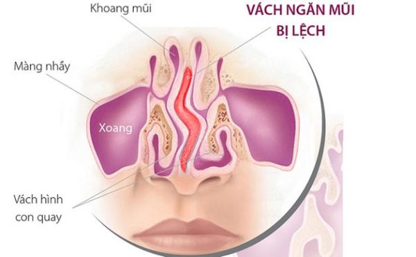 Các cách chữa vẹo vách ngăn mũi không cần can thiệp phẫu thuật khác nhau như thế nào?
