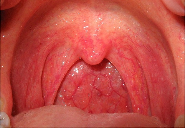Amoxicillin có tác dụng gì trong việc chữa viêm họng?
