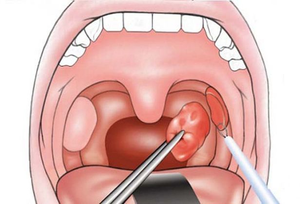 Nằm viện sau phẫu thuật cắt amidan có cần thiết không?
