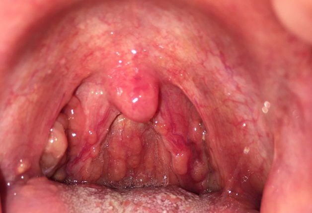 Điều gì gây ra viêm mũi họng mãn tính trở thành một bệnh mạn tính?
