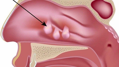 Quá trình phẫu thuật polyp mũi và phục hồi sau phẫu thuật? 
