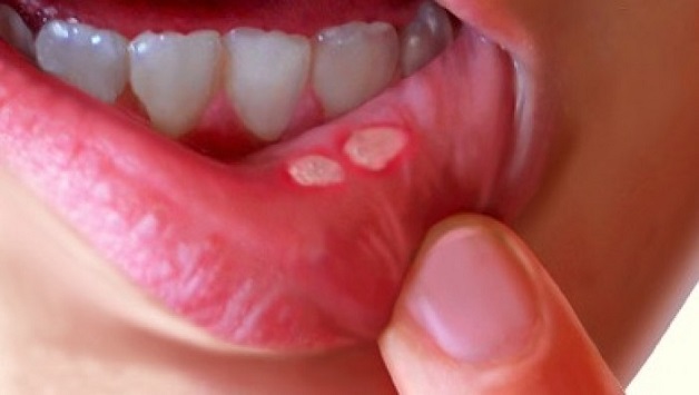 Các loại thuốc uống nào có thể giúp làm dịu triệu chứng nhiệt miệng?
