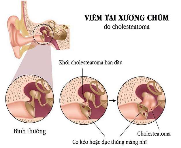 Chi phí trung bình cho việc phẫu thuật viêm tai xương chũm là bao nhiêu?
