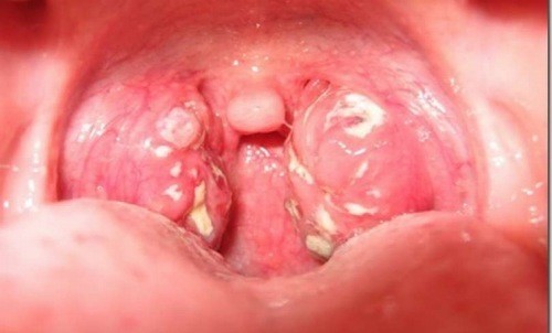 Nguyên nhân gây ra bệnh viêm họng hạt?
