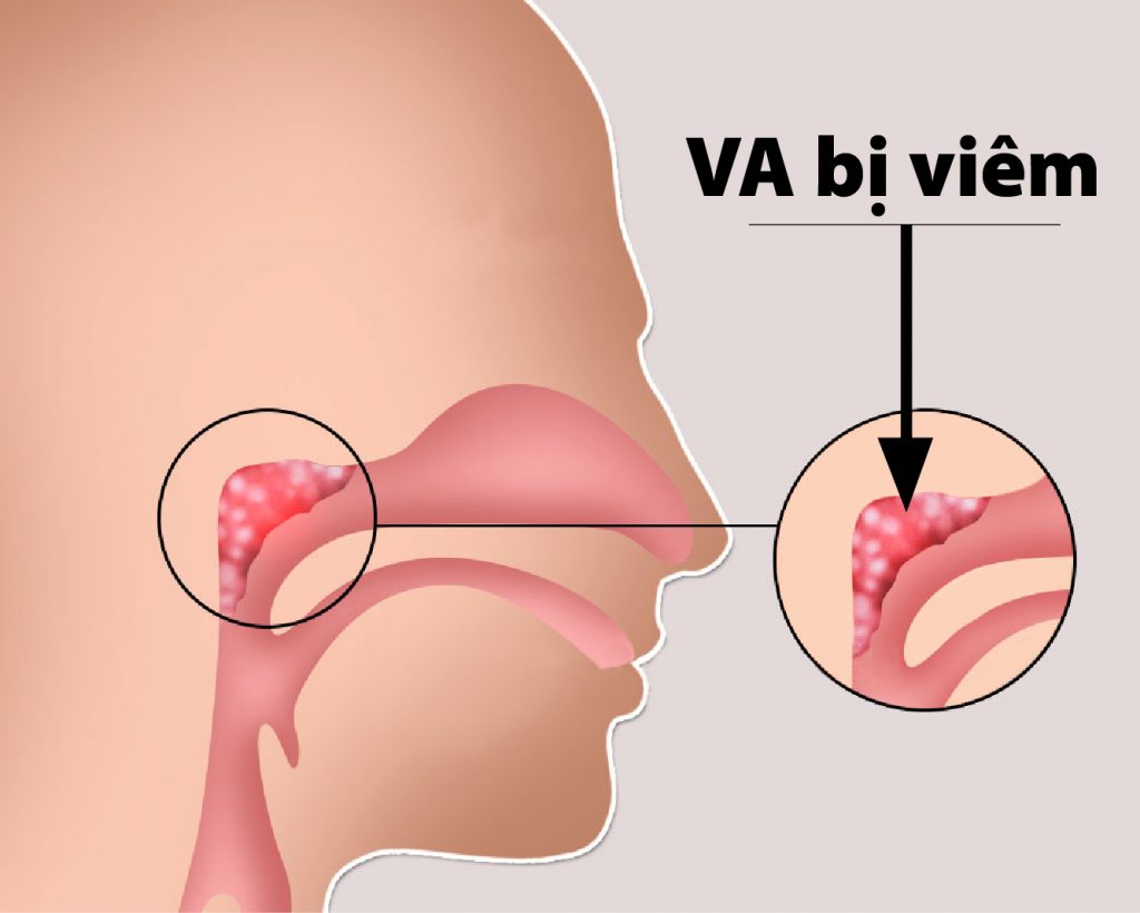 Có những phương pháp phòng ngừa viêm VA nào?