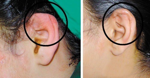 Thuốc giảm đau nào thường được kê cho bệnh nhân viêm sụn vành tai?
