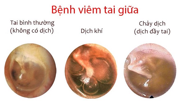 Có những biện pháp phòng ngừa nào để tránh viêm tai giữa ở trẻ sơ sinh?
