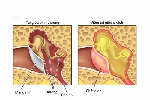 Phác đồ điều trị viêm tai giữa ứ dịch bao gồm những gì?
