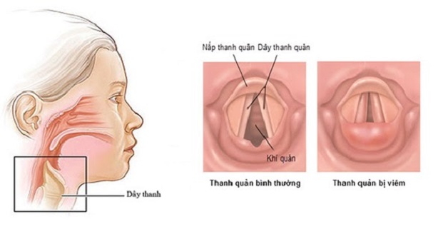 Kiểm tra và chuẩn đoán viêm thanh quản cấp tính như thế nào?
