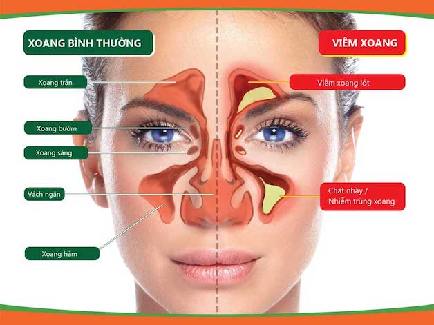 Bệnh viêm xoang hàm có thể tái phát không?
