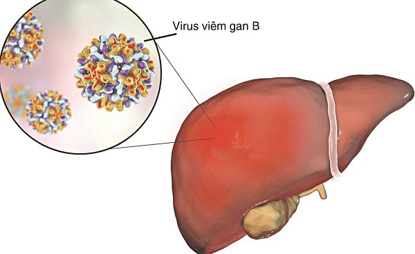 Ai dễ mắc viêm gan B? Bạn hãy đọc để có biện pháp | BvNTP