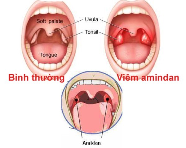 Viêm amidan có thể gây ra biến chứng viêm khớp không?
