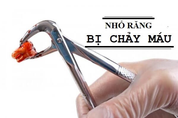 Có thể ngăn chặn máu chảy sau khi nhổ răng không?
