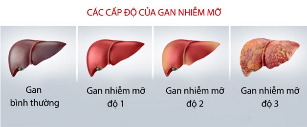 Những điều bạn cần biết về bệnh gan nhiễm mỡ độ 2 | BvNTP