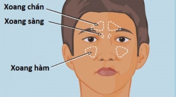 Các triệu chứng chính của viêm xoang sàng sau gáy là gì?
